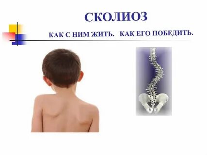Сколиоз работа