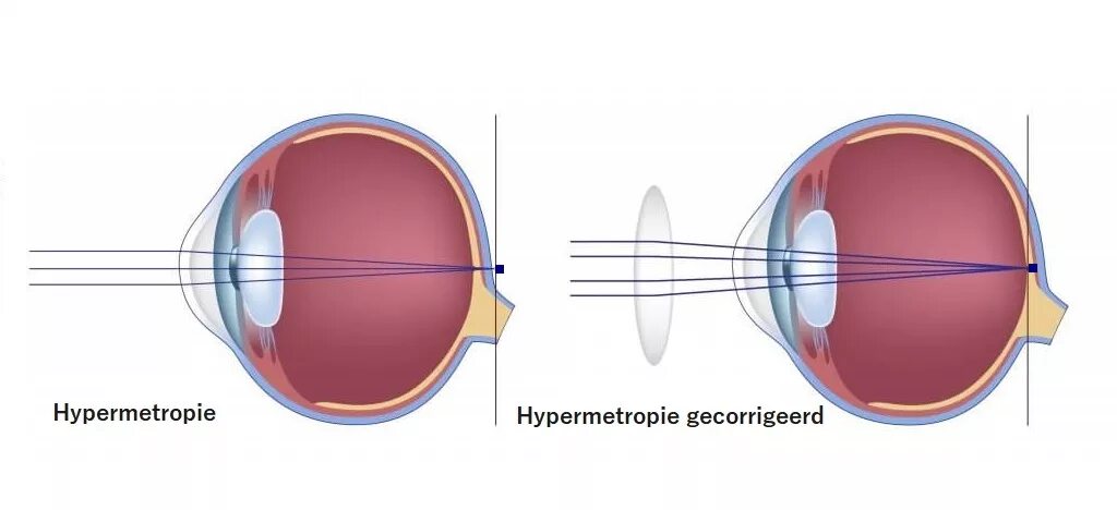Коррекция зрения с помощью линз