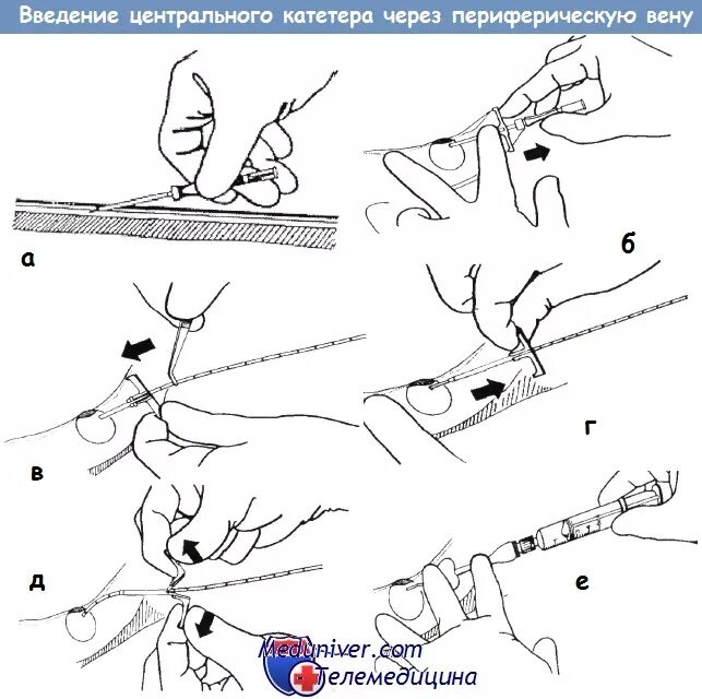 Катетеризация периферических вен схема. Техника постановки кубитального катетера в Вену. Катетеризация периферических вен алгоритм. Техника постановки кубитального катетера в Вену алгоритм. Алгоритм постановки периферического венозного катетера