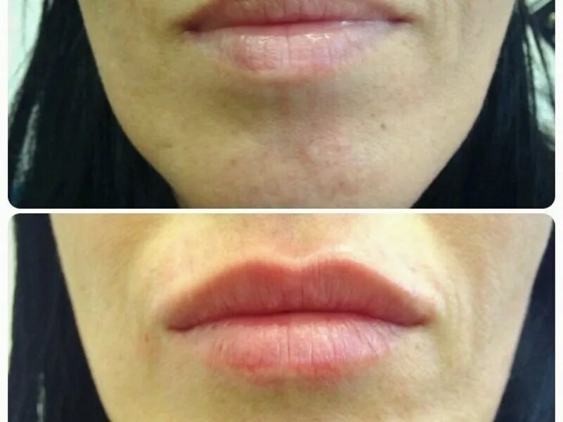 Контурные губы до и после фото. Губы гиалуроновой кислотой. Контурная пластика губ гиалуроновой кислотой. Губы после контурной пластики.
