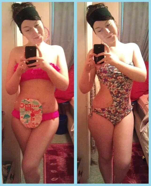 Myself,new swimmers, Ostomy covers, Ostomy bag :) Ostomy fashion, Ostomy bag, Os