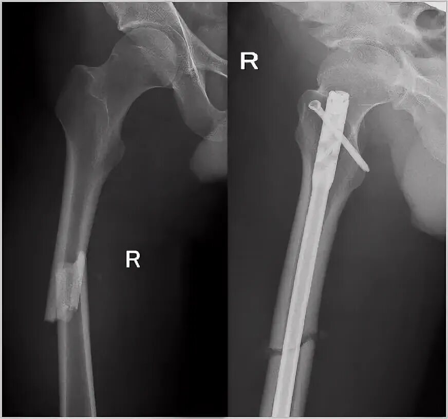 Сколько заживает бедро. Перелом диафиза бедренной кости остеосинтез. Диафизарный перелом рентген. Интрамедуллярный остеосинтез бедра у детей. Внутрикостный остеосинтез перелома бедренной кости.