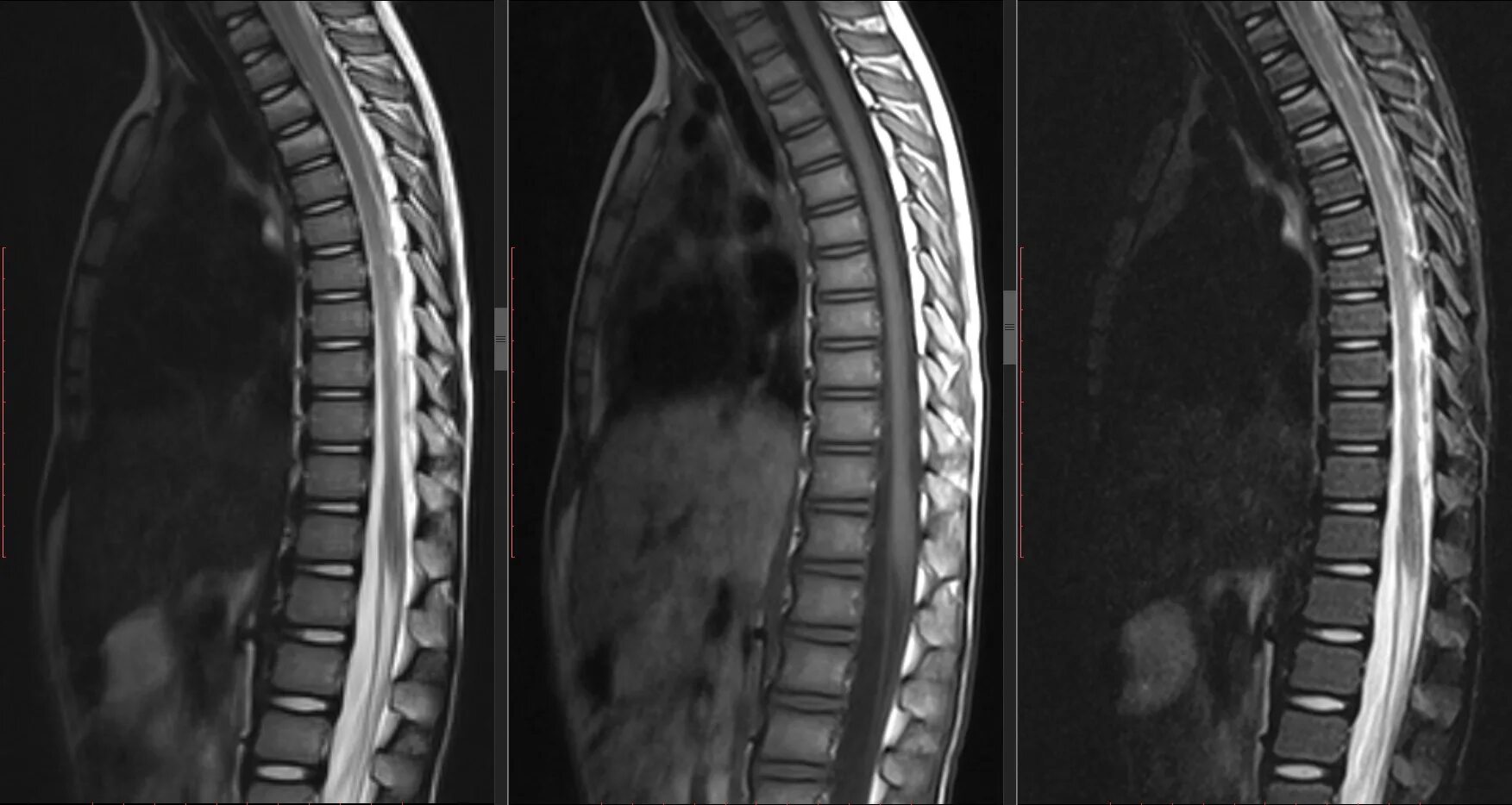 Мрт спинного отдела. Мрт грудного отдела позвоночника сколиоз. Остеохондроз грудного отдела мрт. Мрт грудного отдела норма. Позвоночник на мрт норма сбоку.
