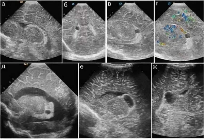 Нейросонография новорожденных кисты сосудистых сплетений. Субэпендимальная киста на УЗИ. НСГ УЗИ головного мозга. УЗИ плода кисты сосудистых сплетений. Сосудистая киста головного мозга у плода