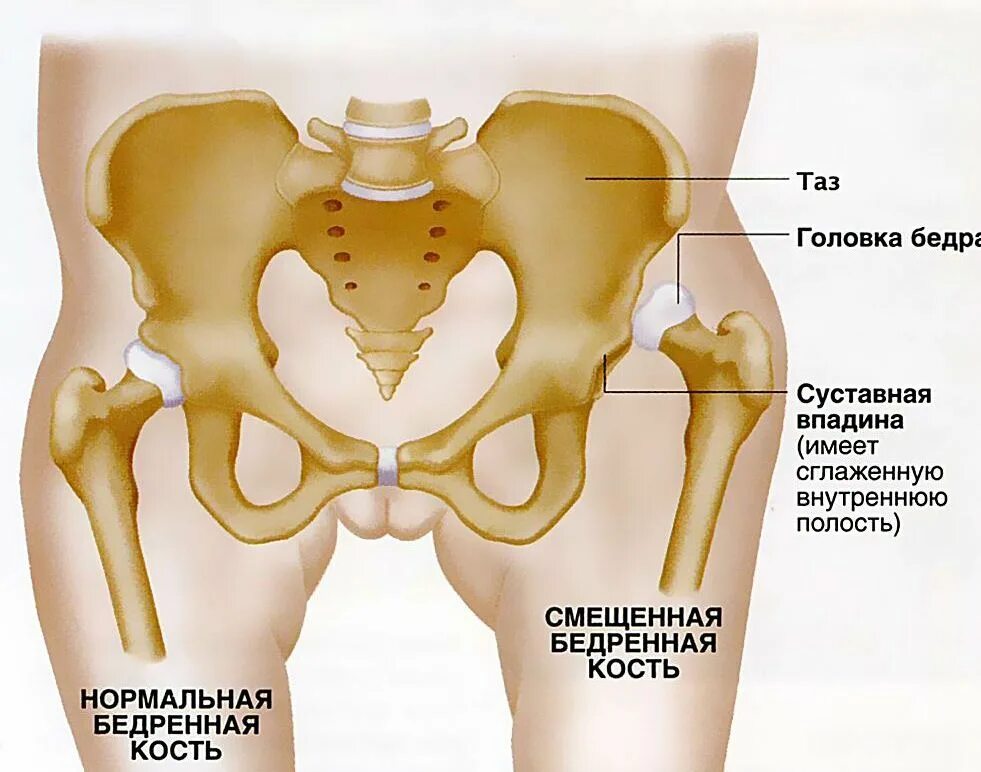 Кость где бедро. Дисплазия вывих тазобедренного сустава. Врожденный вывих тазобедренного сустава. Подвздошная кость суставная впадина. Вывих и подвывих тазобедренного сустава.