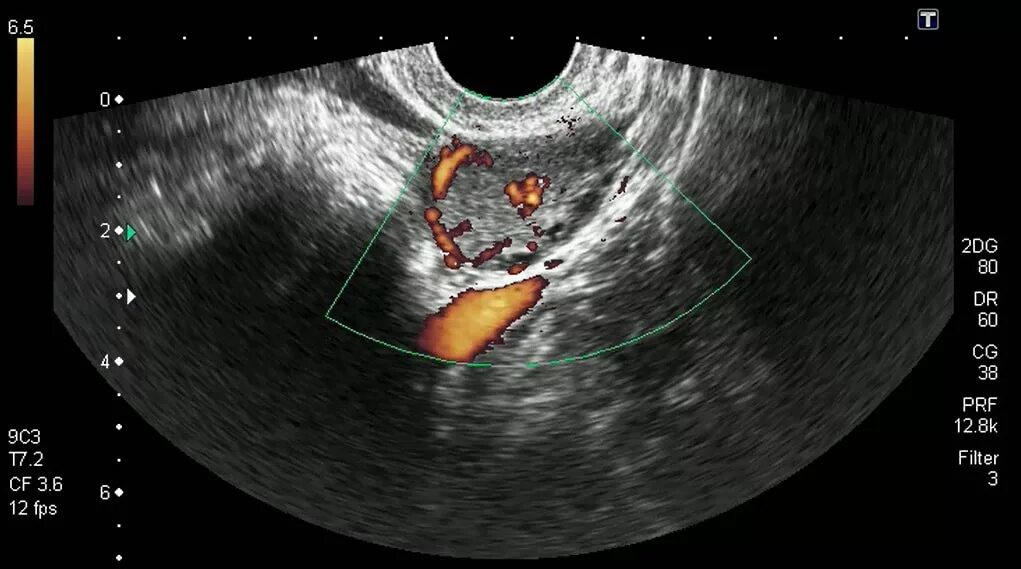 Персистирующий фолликул яичника УЗИ. Предовуляторный фолликул на УЗИ. Лопнула овуляция