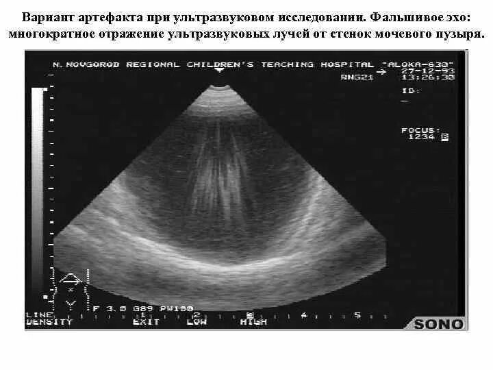 Эффект реверберации. Эффект реверберации на УЗИ. Артефакт реверберации на УЗИ. Артефакт толщины ультразвукового луча. Зеркальный артефакт в УЗИ.