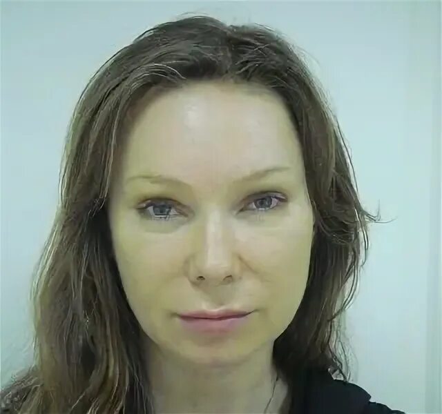 Эндоскопическая подтяжка лба Dr. Patlazhan Clinic Цены, фото, отзывы Пластическа