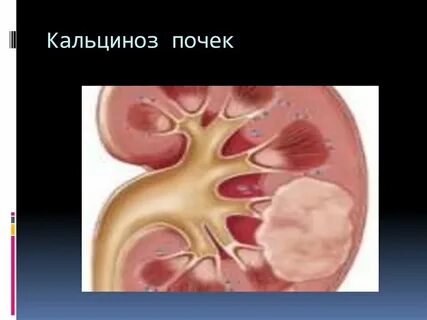 Кальцинаты в почках