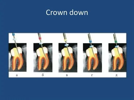Crown down