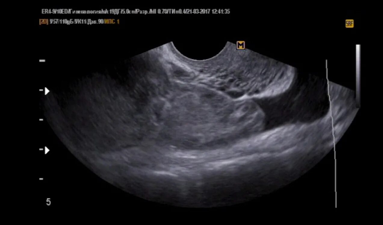 УЗИ малого таза внематочная беременность. Внематочная беременность на УЗИ. УЗИ органов малого таза внематочной беременности. Внематочная беременность на УЗИ фото. Внематочная 5 недель