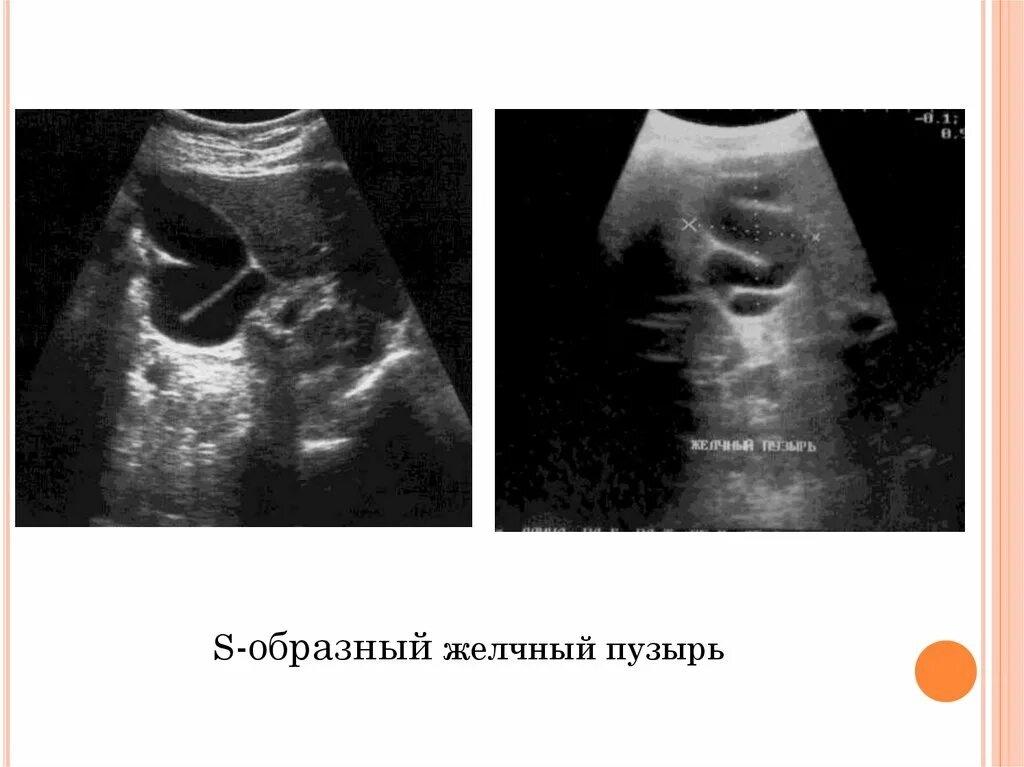 Перегиб желчного пузыря форум. S образный желчный пузырь УЗИ. Аномалия формы желчного пузыря Перегиб. S образный загиб желчного пузыря. Перегиб желчного пузыря на УЗИ.
