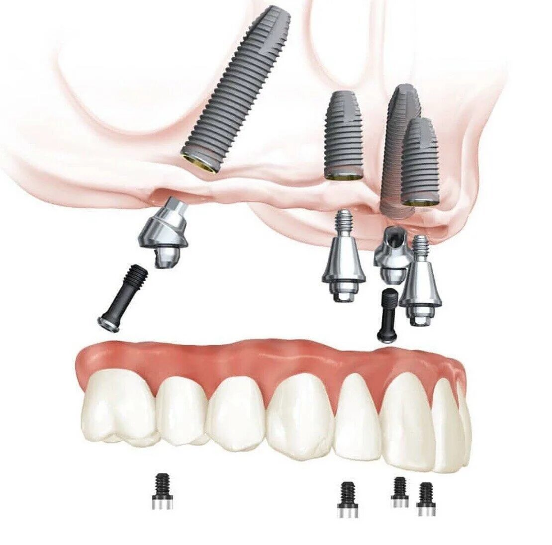 Мульти Юнит система имплантов. Neodent импланты. Протез на 4 имплантах верхней челюсти.