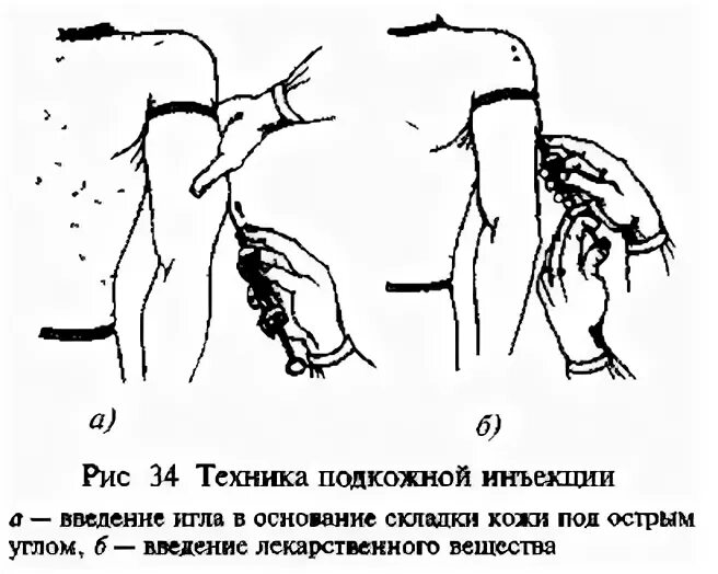 Инъекция подкожно в плечо алгоритм. Схема введения п/к инъекции. Алгоритм инъекции лекарственных средств подкожно. Алгоритм постановки подкожной инъекции в плечо. Подкожные инъекции техника выполнения