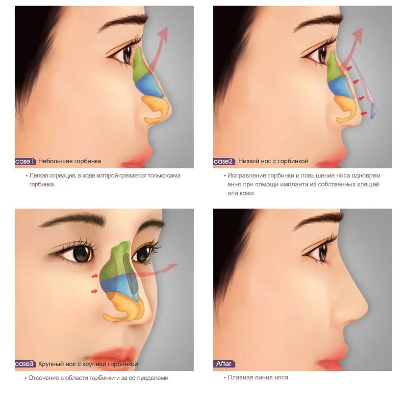 Нос с горбинкой. Ринопластика горбинки носа. Упражнения для горбинки на носу.