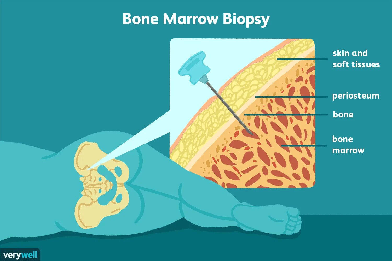 Трепанобиопсия пунктат костного мозга. Аспирация костного мозга. Аспирационная биопсия костного мозга.
