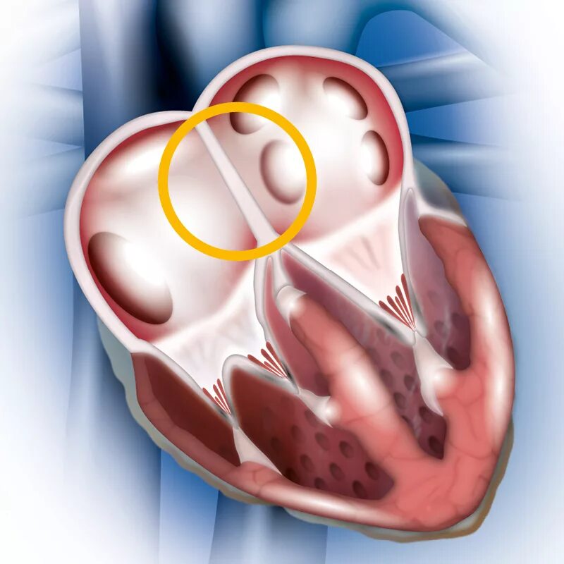 Foramen ovale сердце. Врожденные пороки сердца окклюдер. Порок сердце операция аклюдер.