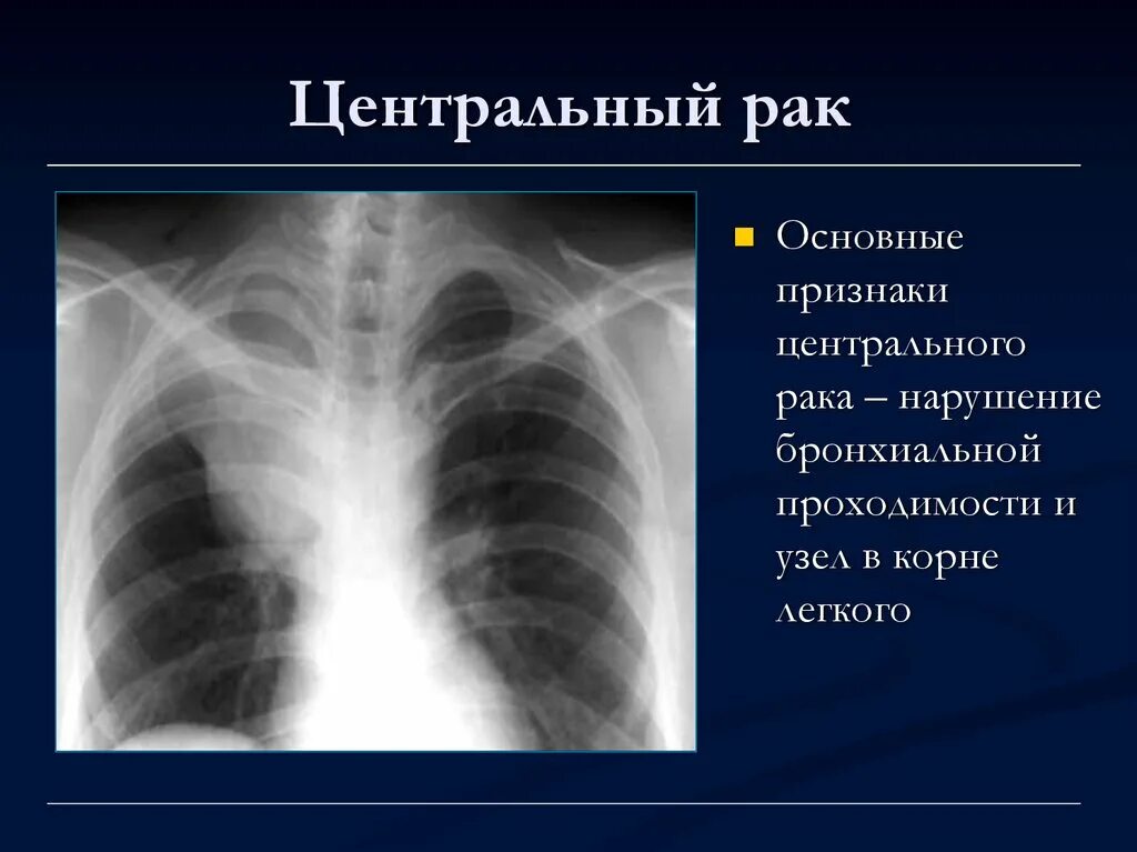 Центральный рак правого. Уентральныйрак легкого. Центральная опухоль легкого. Плевральные наслоения.