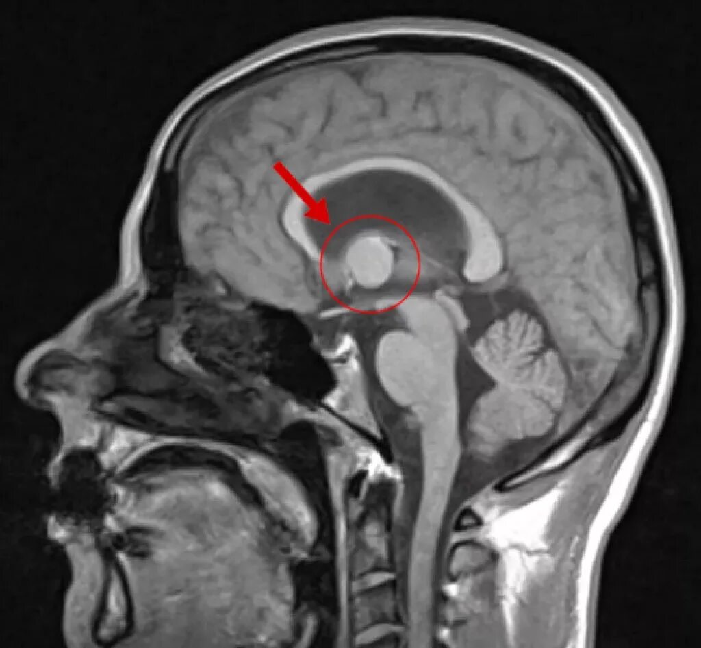 Киста мозга рассосалась. Ретроцеребеллярная киста мрт. Киста желудочка головного мозга мрт.