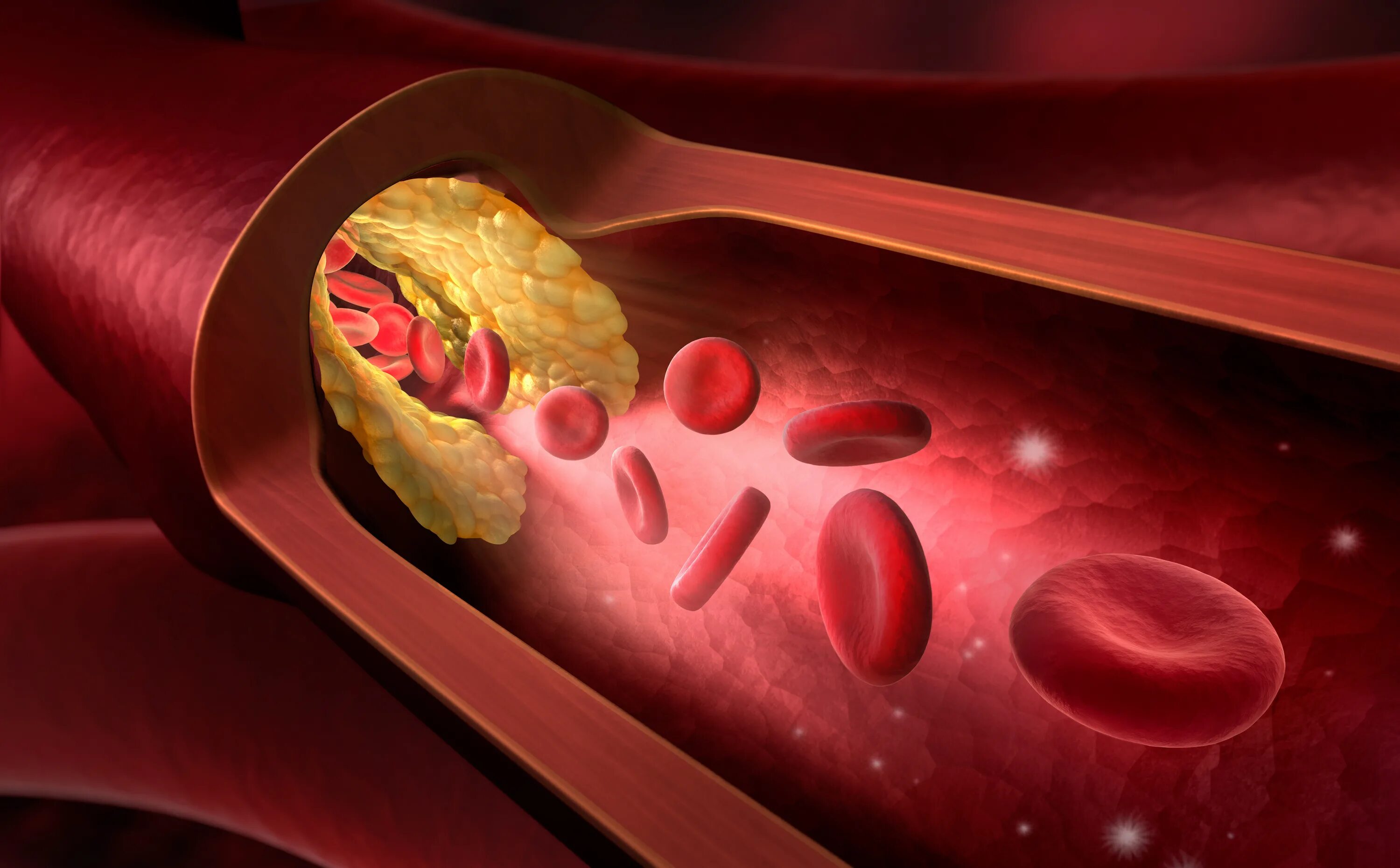 Холестериновые бляшки в крови. Атеросклероз иллюстрация. Атеросклероз фон. Холестериновые бляшки на коже.