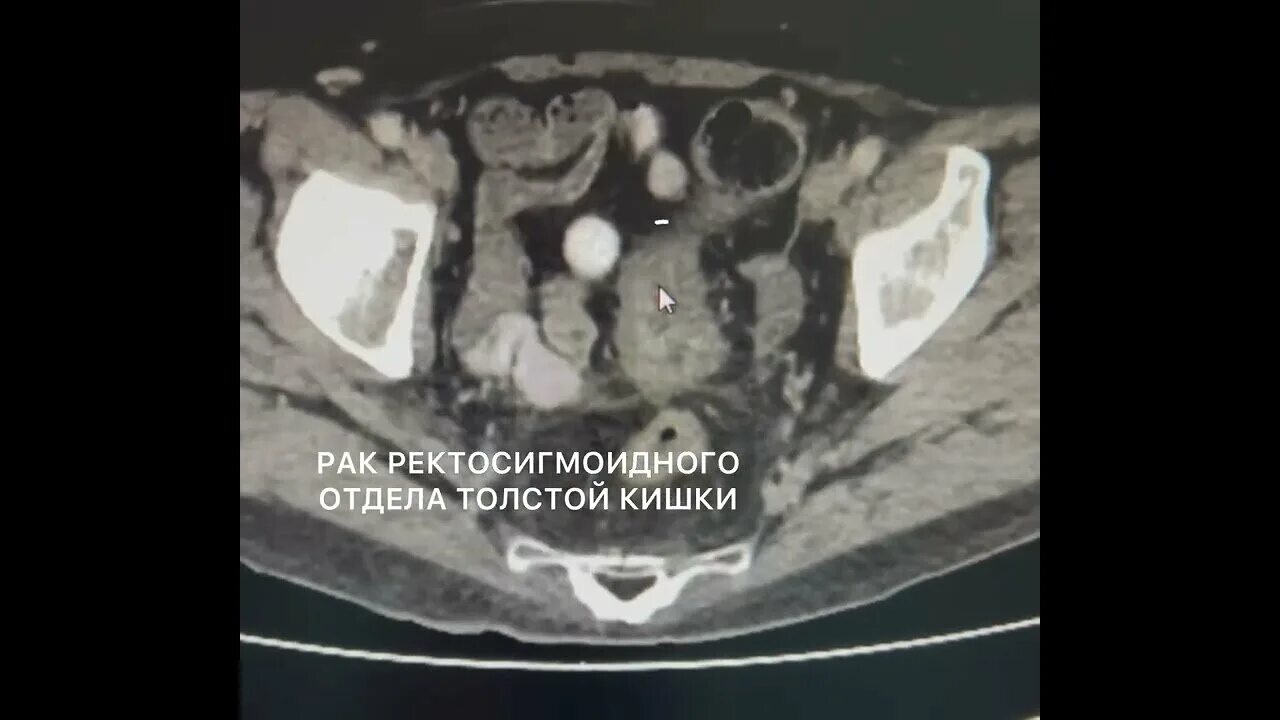 ректосигмоидный отдел толстой кишки. ректосигмоидный отдел толстой кишки анатомия. правосторонняя гемиколэктомия ободочной кишки. неоплазия ободочной кишки. экзофитные опухоли толстого кишечника.