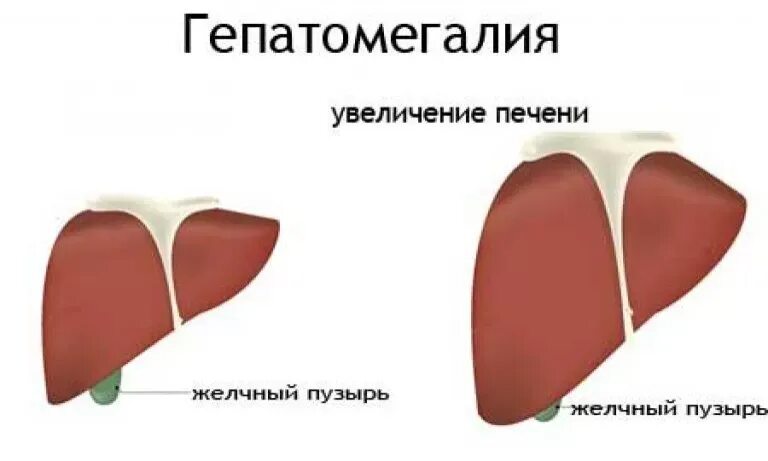 Может ли уменьшиться печень. Размеры печени при гепатомегалии. Увеличение размеров печени. Увеличение печени причины. Диффузные изменения печени.