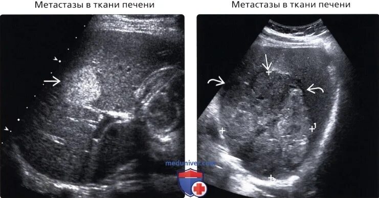 Образование в печени на узи. Гиперэхогенные образования в печени на УЗИ. Гиперэхогенное образование в печени по УЗИ. Метастазы в печень гиперэхогенные УЗИ. Гиперэхогенное образование в печени на УЗИ что это такое.