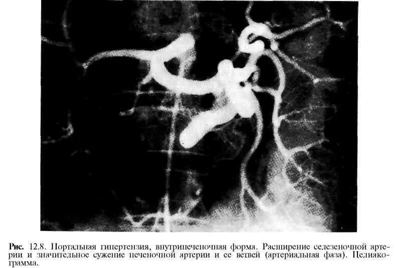 Расширение селезеночных вен. Предпеченочная портальная гипертензия. Синдром воротная Вена. Портальная гипертензия вены. Сосудистая мальформация селезеночной артерии.