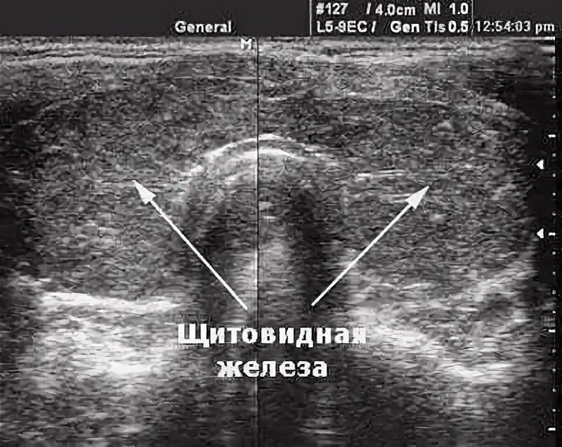 Эхоструктура железы диффузно неоднородная. Щитовидная железа диффузно неоднородная УЗИ. Паренхимы щитовидной железы на УЗИ. Эхогенность снижена УЗИ щитовидная железа. Эхогенность щитовидная железа на УЗИ.