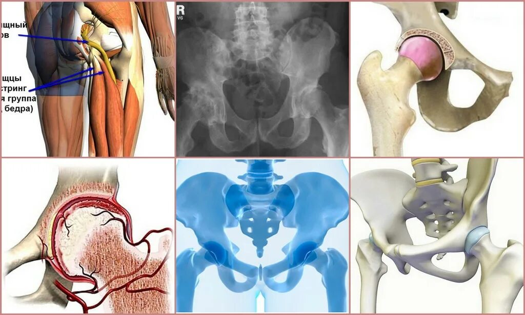Болит бедро операция. Коксартроз тазобедренного сустава. Коксартроз тазобедренного упражнения. Инволютивный коксартроз тазобедренного. Коксалгия тазобедренного сустава.