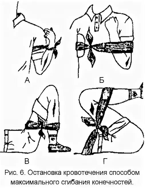 Способы временной остановки кровотечения наложение давящей повязки