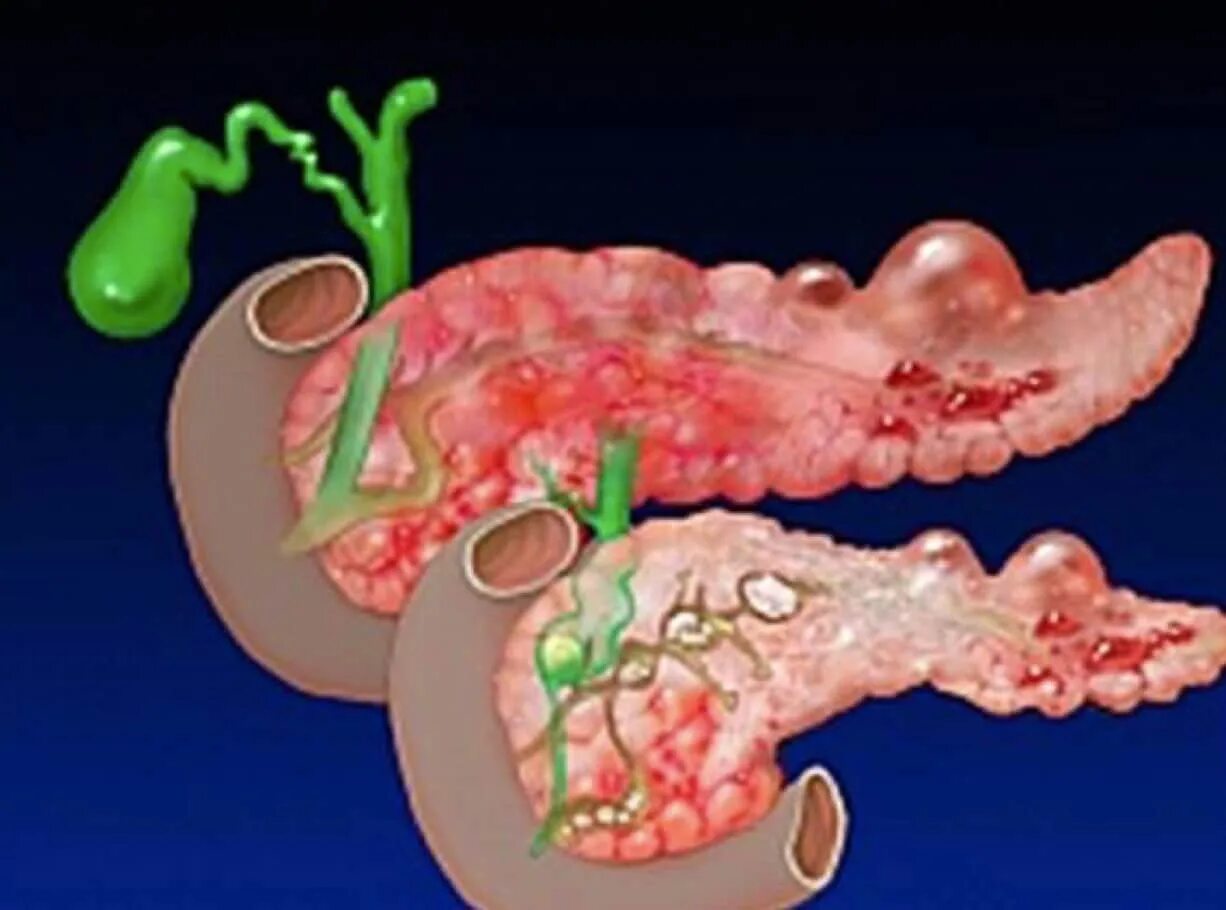 Хронический панкреатит панкреонекроз. Острый панкреатит панкреонекроз. Острый панкреатит, некроз поджелудочной. Панкреатит и панкреонекроз. Хронический холецистит поджелудочной железы
