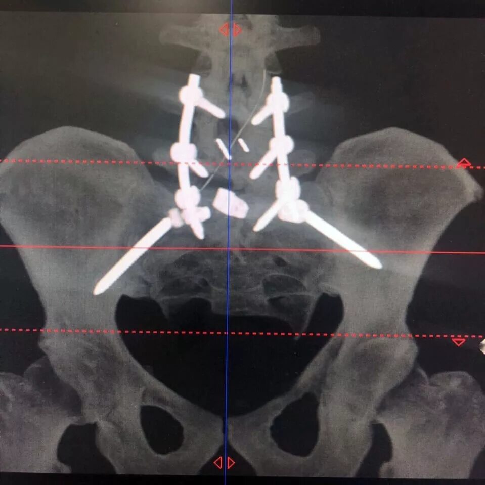 Транспедикулярная фиксация рентген. Транспедикулярная фиксация поясничного отдела. Остеосинтез позвоночника транспедикулярной. Транспедикулярная фиксация th11-l2. Сидеть после операции на позвоночнике поясничного