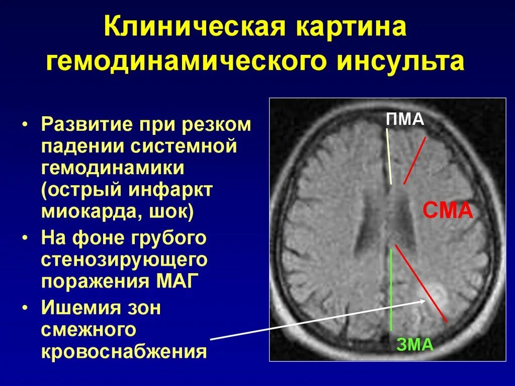 Инсульт в ПМА. ОНМК В ПМА. Инсульт задней мозговой артерии. Ишемический инсульт в бассейне СМА.