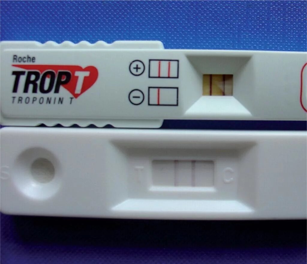 Экспресс тест на инфаркт. Экспресс тест на тропонин. Тропониновый тест полоска. Тест на тропонин экспресс-тест на инфаркт. Тропониновый тест при инфаркте миокарда.