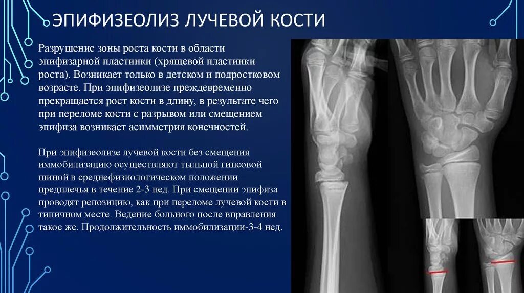 Растяжение связок лучезапястного мкб 10