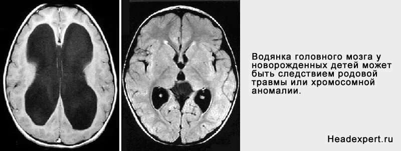 Наружная гидроцефалия головного мозга у новорожденного. Гидроцефалия патанатомия. Гидроцефалия головного мозга у плода по УЗИ на. Гидроцефалия головного мрт.