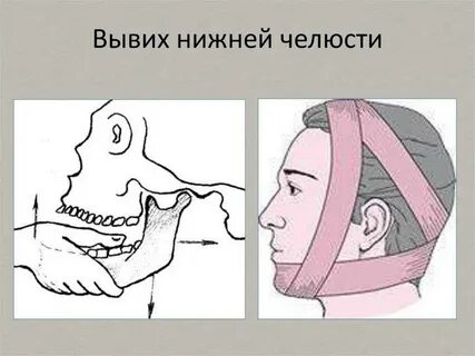 Нижний вывих
