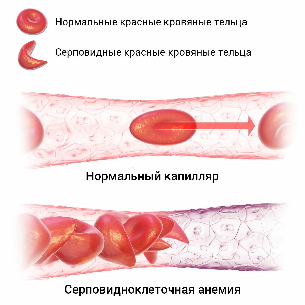 Серповидно-клеточная анемия. Серповидно коеточная анемия. Эритроциты при серповидноклеточной анемии. Скрповидно клеточная анемия