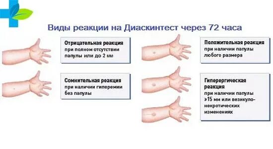 Папула диаскинтест манту. Оценка реакции манту и диаскинтеста. Гиперергическая реакция на диаскин тест. Диаскинтест – 4 мм папула.