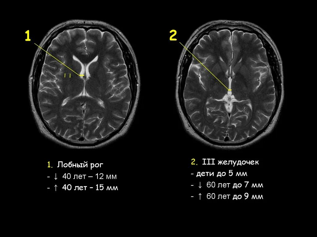 Желудочки головного мозга кт анатомия. Ширина боковых желудочков на кт. Третий желудочек головного мозга кт. 3 Желудочек головного мозга норма кт. Расширение желудочков дети