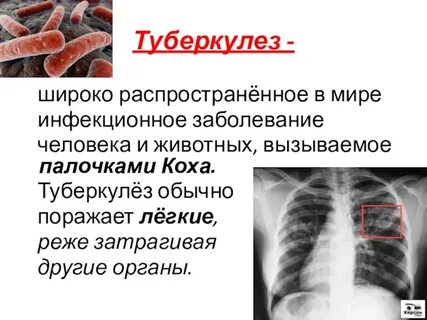 Болезнь туберкулез