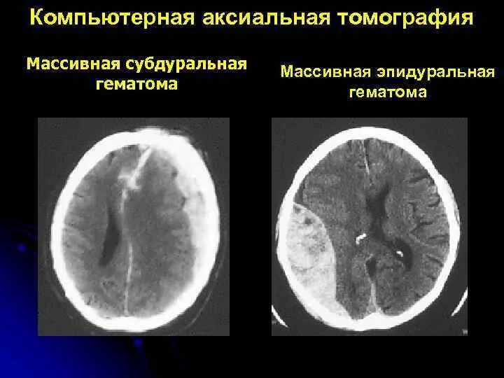 Объем гематомы на кт