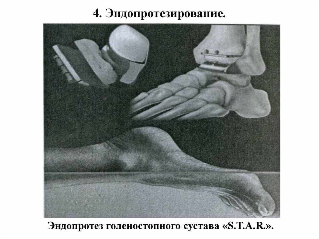 Изменения голеностопного сустава. Эндопротезирование голеностопа. Эндопротез голеностопного сустава. Эндопротезирование голеностопного сустава фото. Эндопротезирования голеностопа этапы.