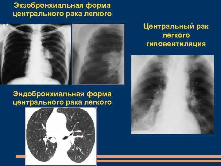 Уентральныйрак легкого. Центральная опухоль легкого. Гиповентиляция верхней доли рентген. Перибронхиальная опухоль. Центральный рак правого