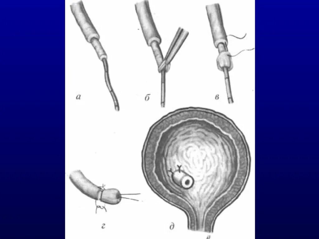 Эктопия устьев мочеточников это. Эндопластика устья мочеточника. Реимплантация мочеточника в мочевой пузырь.