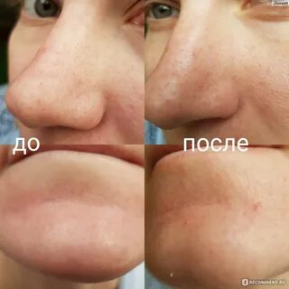 Лучшее средство от комедонов