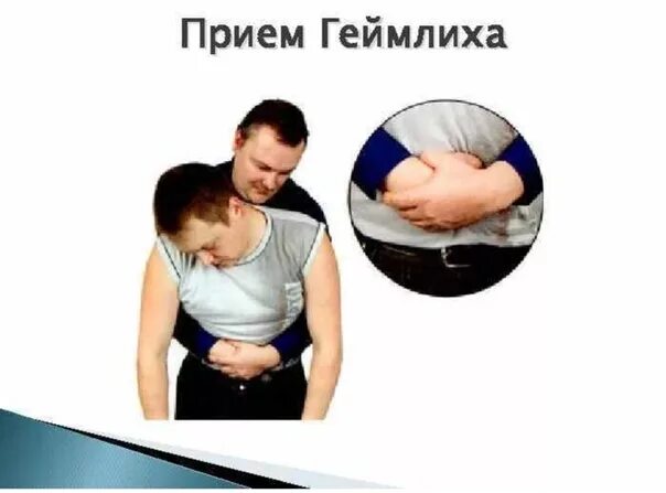 Выполнение приема геймлиха