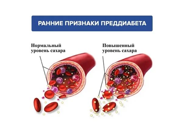 Преддиабет что это и как лечить. Проявления преддиабета. Преддиабет симптомы. Прдиабет симптом. Показания преддиабета.