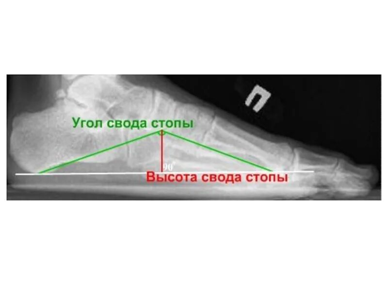 Плоскостопие 3 степени сколько градусов. Угол продольного свода стопы 160 градусов. Степени плоскостопия на рентгене. Плоскостопие 3 степени высота свода. Угол продольного внутреннего свода стопы.